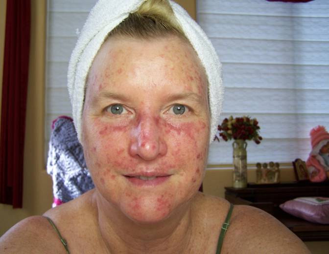 random-red-patches-on-face-rosacea-facial-redness-acne